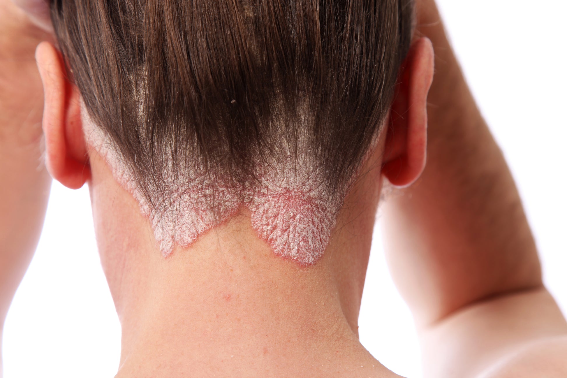 Psoriasis Scalp